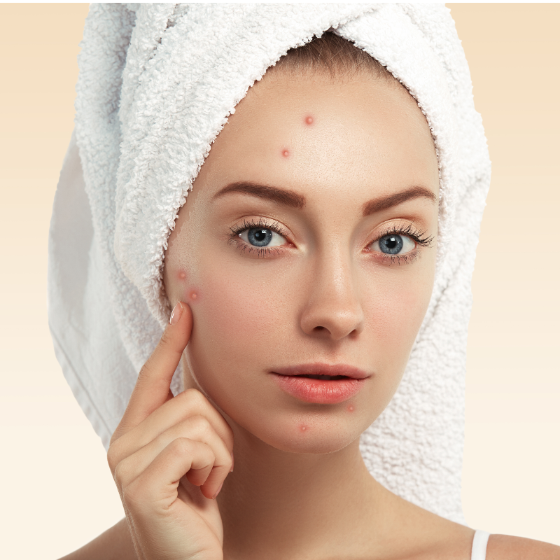 articolo acne