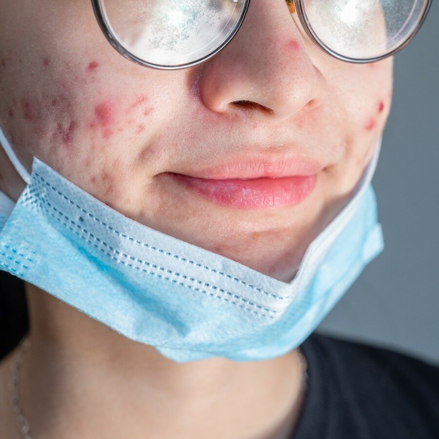 articolo acne da mascherina