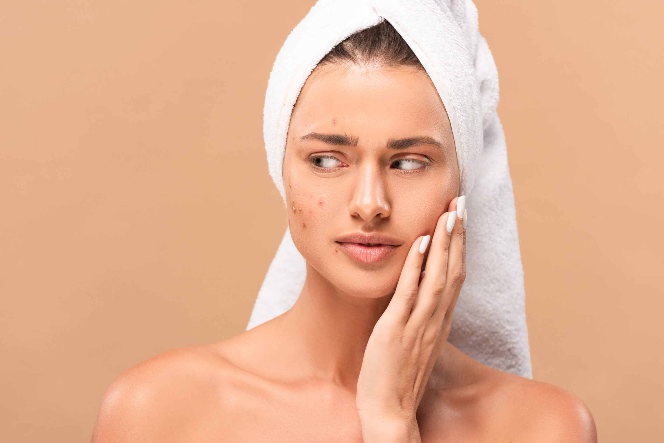 nude girl in towel touching face with acne and looking away isolated on beige
